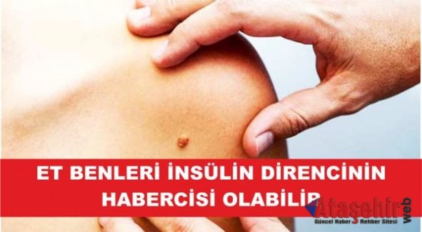 ET BENLERİ İNSÜLİN DİRENCİNİN HABERCİSİ OLABİLİR