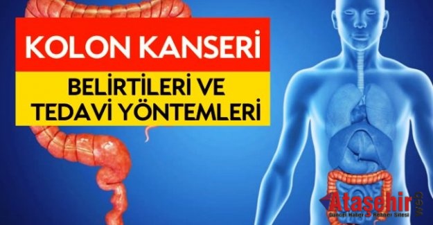 Kolon kanserinde 50 yaş sonrası kontrol önemli