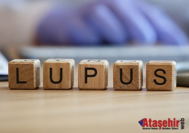 Yüzünüzdeki Lekeler Lupus Belirtisi Olabilir 