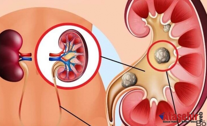 Böbrek Taşının Oluşumu