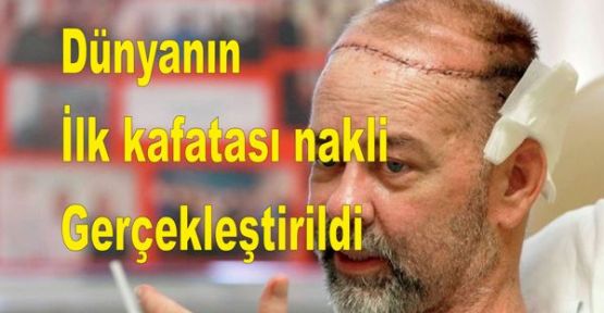 Dünyanın ilk kafatası nakli gerçekleştirildi