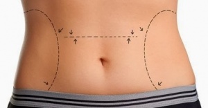 Lazer lipolizle yaza kadar sıkılaşın