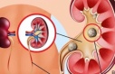 Böbrek Taşının Oluşumu