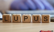 Yüzünüzdeki Lekeler Lupus Belirtisi Olabilir 