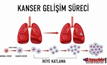4. Evre Kanserde Tedavi Seçenekleri ve Umut