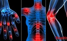 Eklem Kireçlenmesi Sessizce Yayılıyor: Erken Tanı Hayat Kurtarıyor