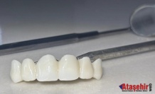 Sivas’ta Devlet Eliyle Gülümseme: Zirkonyum Kaplama Artık Herkes İçin Ulaşılabilir