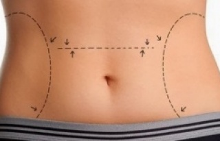 Lazer lipolizle yaza kadar sıkılaşın