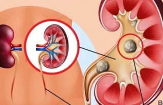 Böbrek Taşının Oluşumu