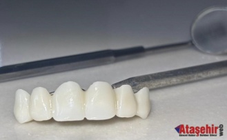 Sivas’ta Devlet Eliyle Gülümseme: Zirkonyum Kaplama Artık Herkes İçin Ulaşılabilir