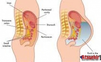 Karında Su Birikimi: Kanserin Sessiz Alarmı