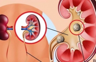 Böbrek Taşının Oluşumu