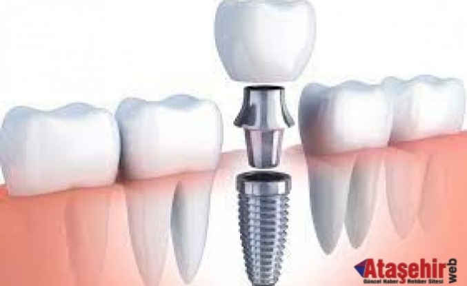 Diş İmplantları: Gülümseme Koruyucularınız