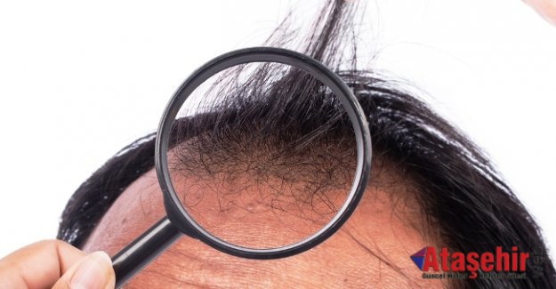 Saç dökülmesi bu hastalıkların işareti olabilir
