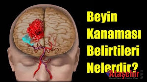 BEYİN KANAMASININ 10 BELİRTİSİNE DİKKAT!