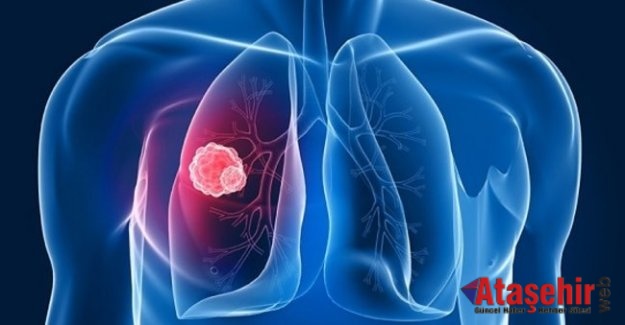 Akciğer kanseri neden olur