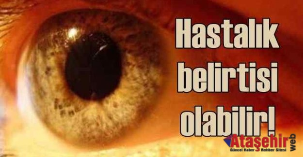 Açık göz renginde sarı nokta hastalığı riski daha fazla