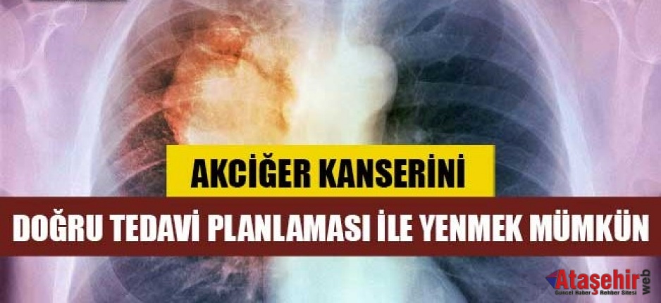 AKCİĞER KANSERİNİ DOĞRU TEDAVİ PLANLAMASI İLE YENMEK MÜMKÜN