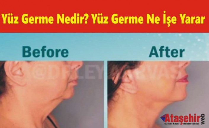 Yüz Germe Nedir? Yüz Germe Ne İşe Yarar?