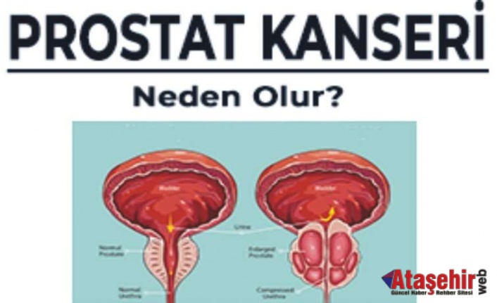 Prostat kanseri nedir?