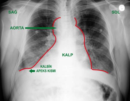 Kalbi sağda bulunan gurbetçinin 5 damarı değiştirildi