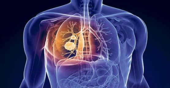  Akciğer Kanserinin Tedavisinde Önemli Adım