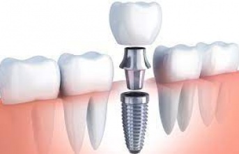 Diş İmplantları: Gülümseme Koruyucularınız