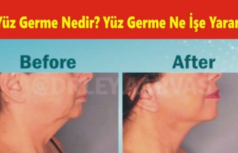 Yüz Germe Nedir? Yüz Germe Ne İşe Yarar?