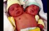 Brezilya’da çift başlı doğan erkek bebek Dünya'nın ilgisini çekti