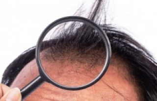 Saç dökülmesi bu hastalıkların işareti olabilir