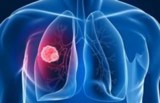 Akciğer kanseri neden olur