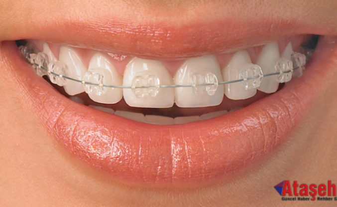 Estetik Diş Hekimliğinde Ortodonti